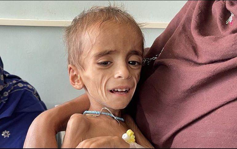 Un niño con desnutrición en Kandahar, en Octubre. GETTY IMAGES